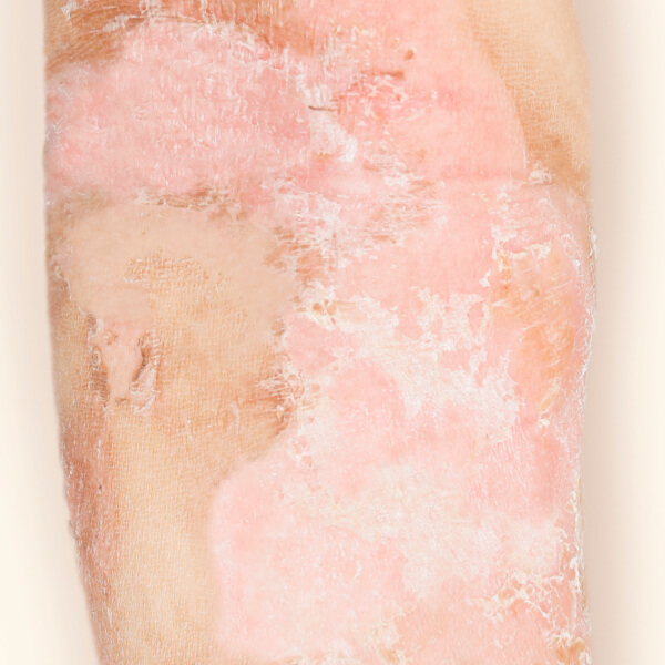Burn Scars
