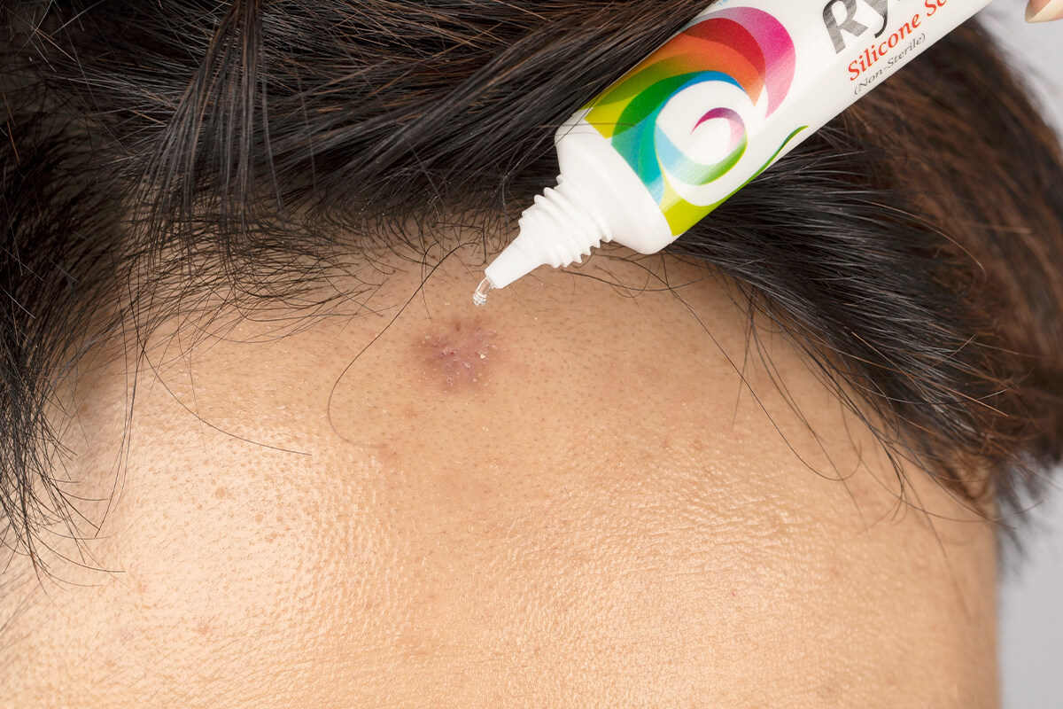 Silicone Scar Gel