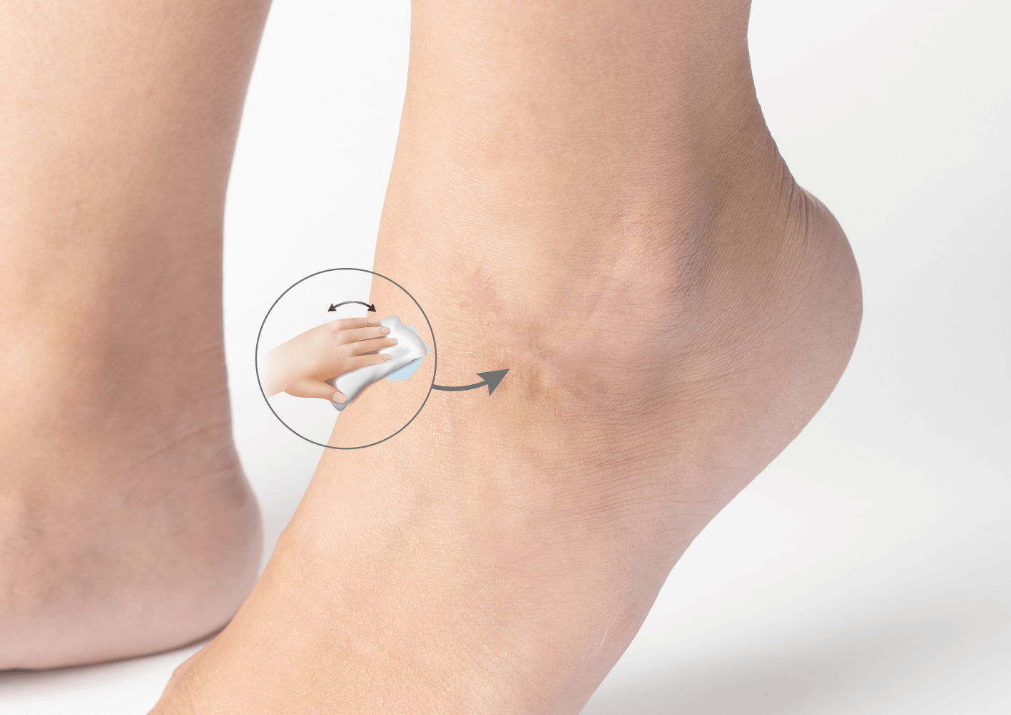 Silicone Scar Tape